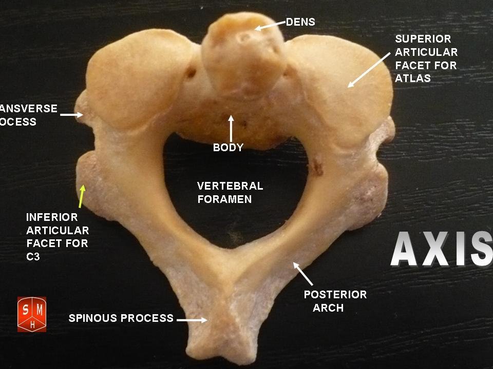 C2 - C3 Vertebrae Fracture - Symptoms, Diagnosis, Treatment
