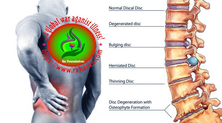 Intervertebral Disc Herniation - Causes, Symptoms, Treatment