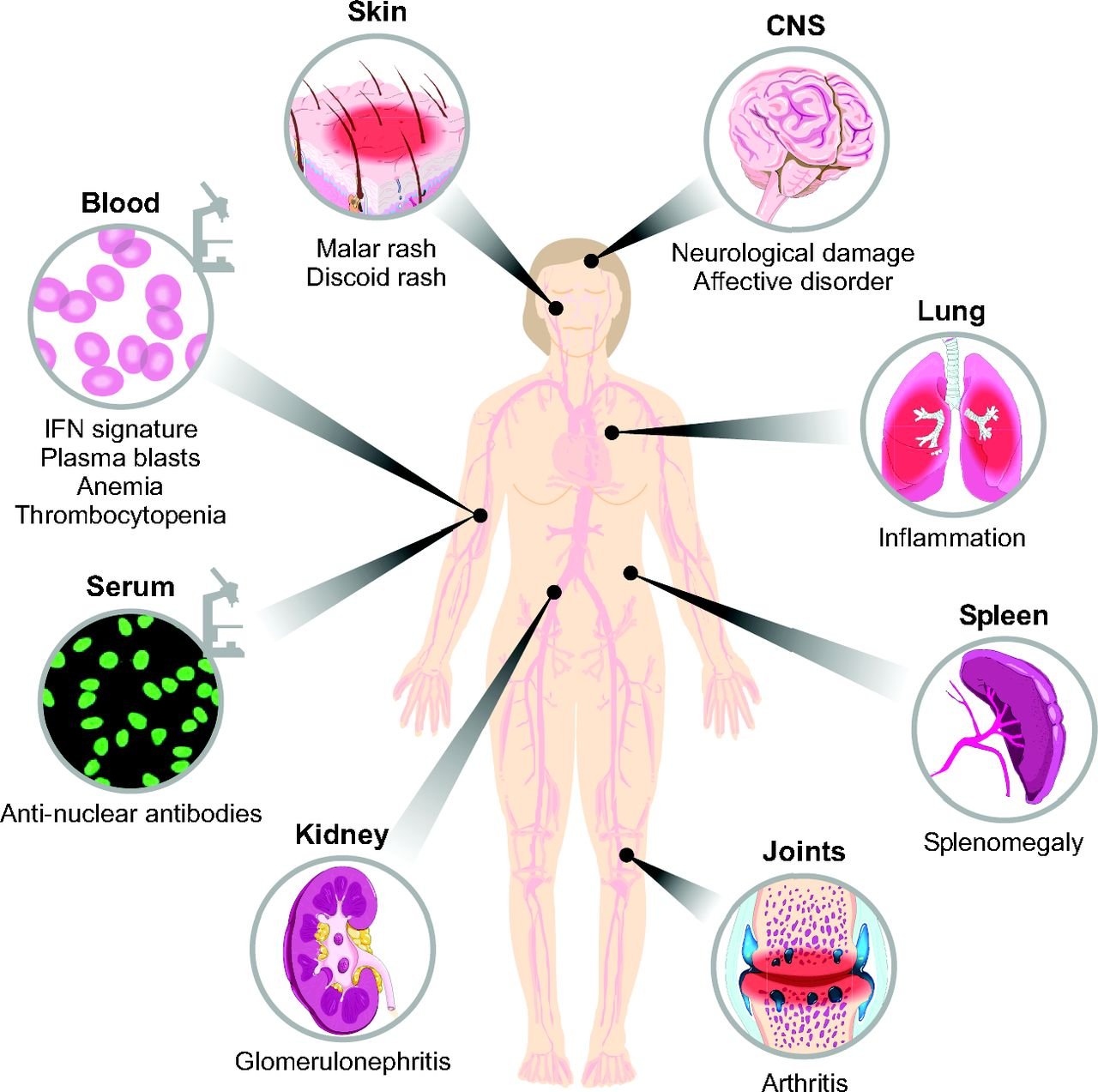 Systemic Lupus Erythematosus - Symptoms, Treatment