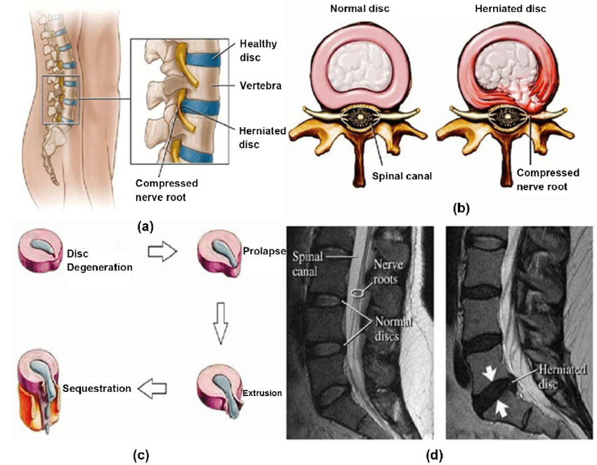 Intervertebral Disc Herniation - Causes, Symptoms, Treatment