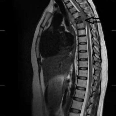 Slipped Disc - Causes, Symptoms, Diagnosis, Treatment