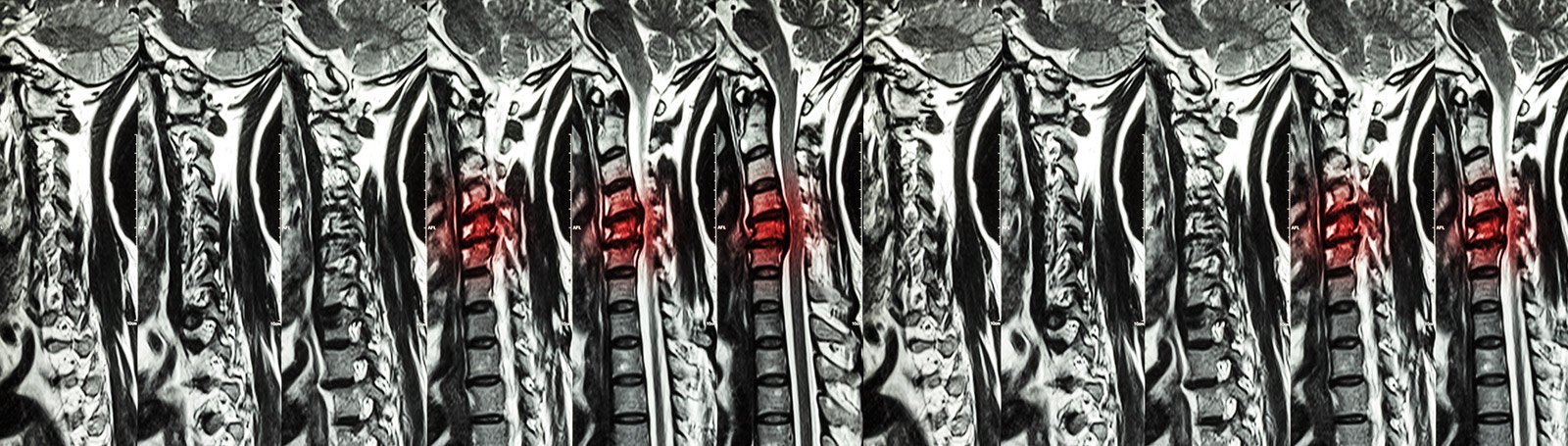 Treatment of Spinal Cord Injury - Complication, Prevention