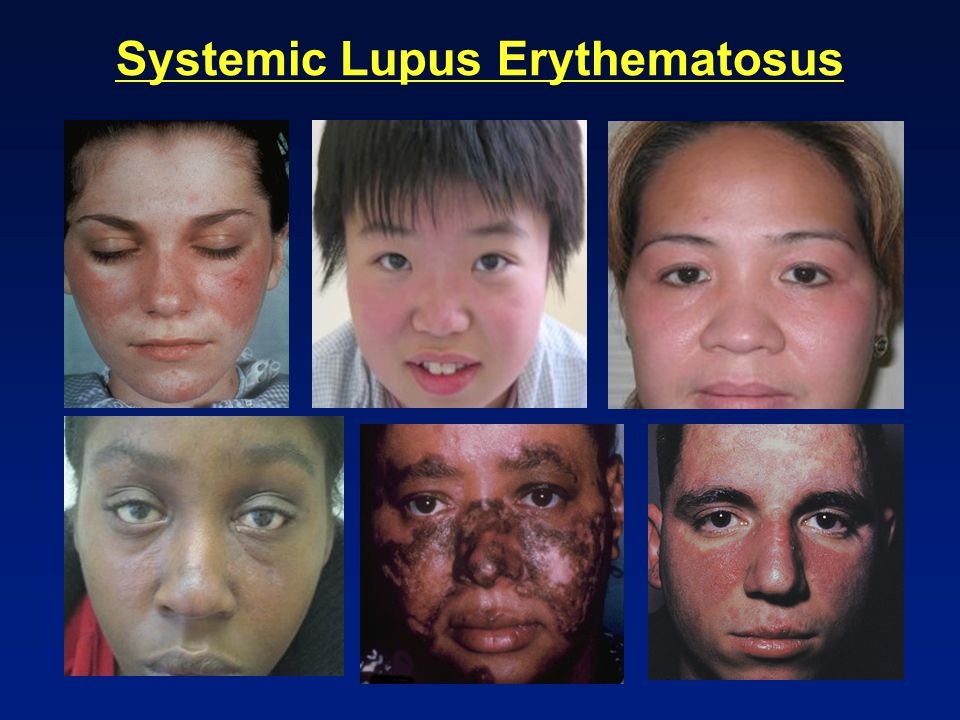 Systemic Lupus Erythematosus - Symptoms, Treatment
