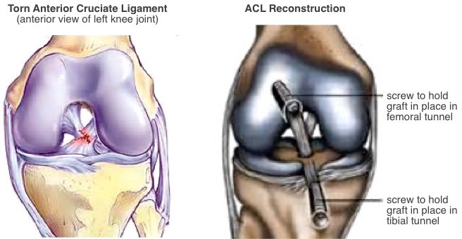 Contraindications and Complication of Knee Arthroplasty