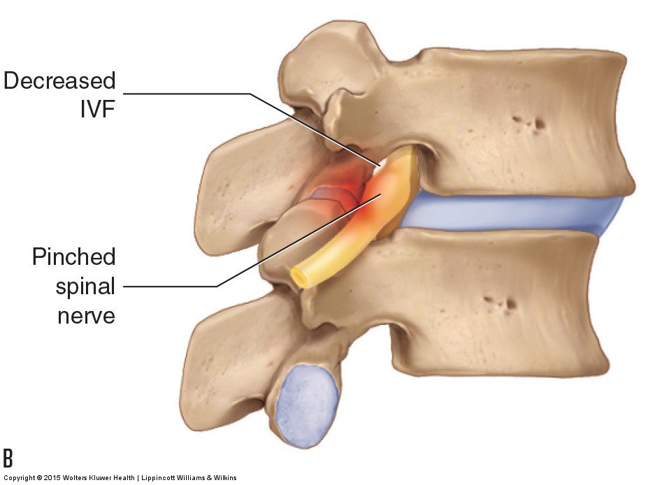 Slipped Disc - Causes, Symptoms, Diagnosis, Treatment