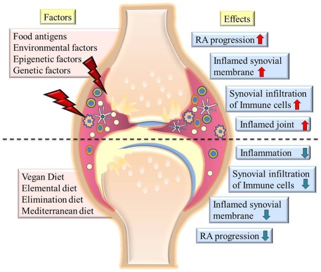 Chronic Inflammatory Arthritis - Causes, Symptoms, Treatment