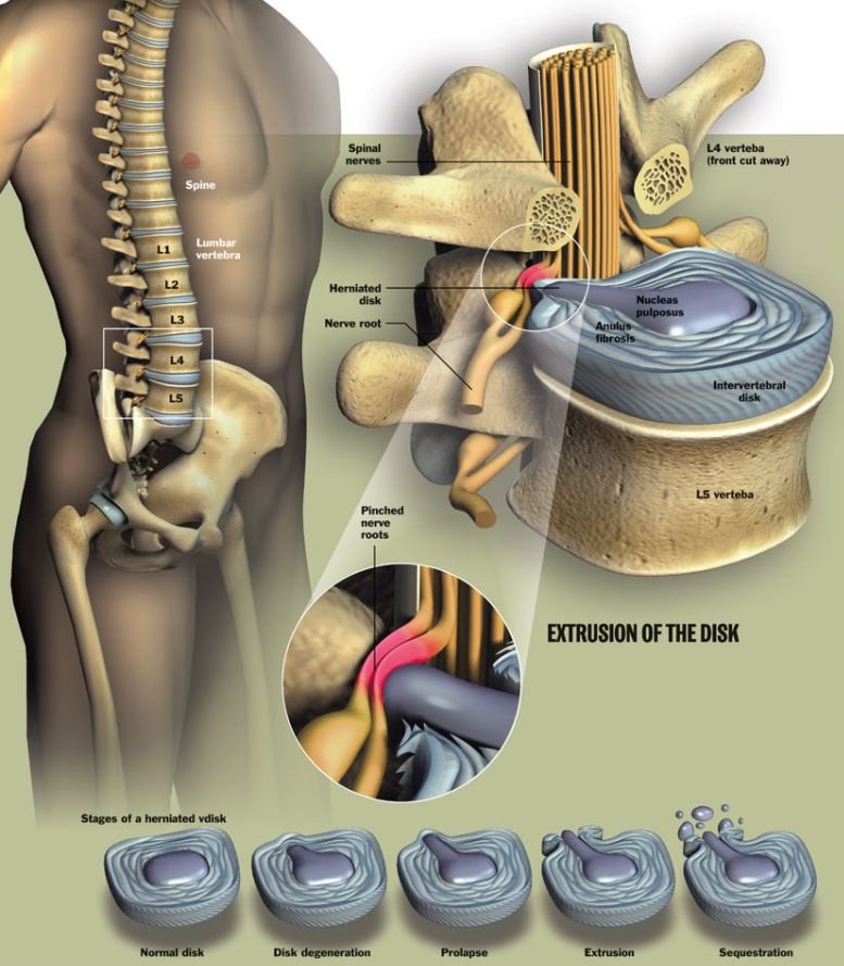 Intervertebral Disc Herniation - Causes, Symptoms, Treatment
