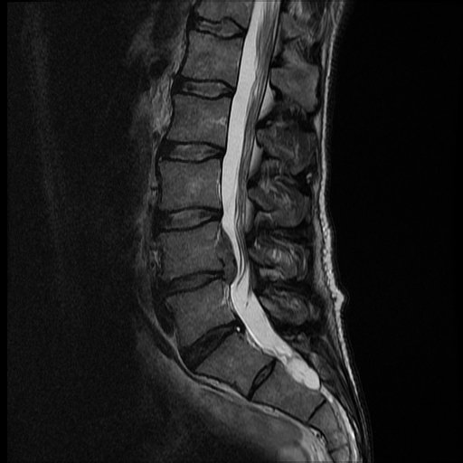 Treatment of Tuberculous Spondylitis - Causes, Symptoms,