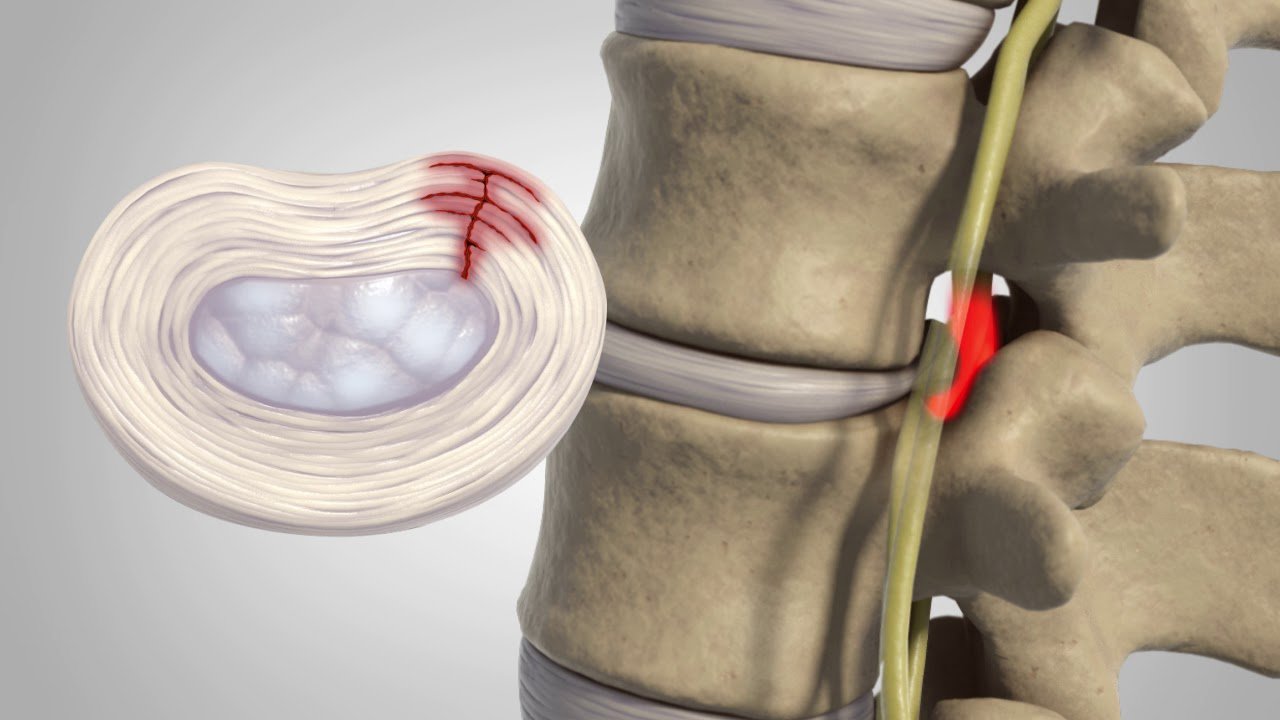 Slipped Disc - Causes, Symptoms, Diagnosis, Treatment
