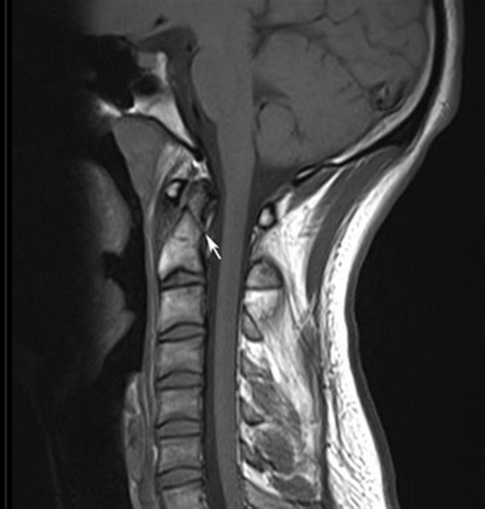 C2 - C3 Vertebrae Fracture - Symptoms, Diagnosis, Treatment