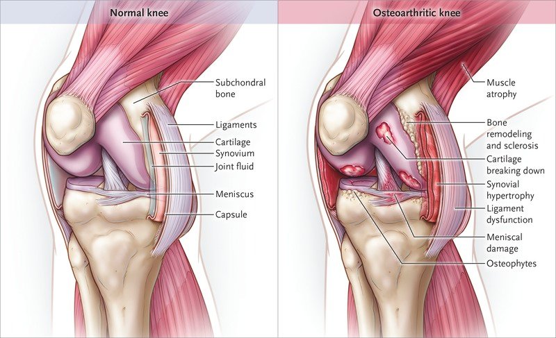 First Symptoms Of Knee Joints Osteoarthritis