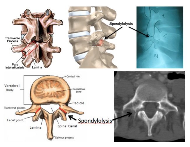 Pars Interarticularis Injury  - Causes, Symptoms, Treatment