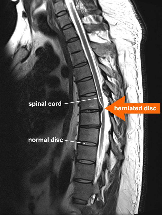 Intervertebral Disc Herniation - Causes, Symptoms, Treatment