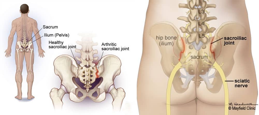 Sacroiliac Joint Trauma - Causes, Symptoms, Treatment