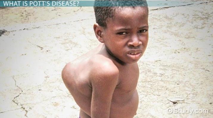 Treatment of Tuberculous Spondylitis - Causes, Symptoms,