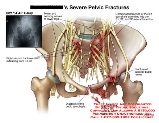 Sacroiliac Joint Trauma - Causes, Symptoms, Treatment
