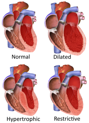 What Is Ischemic Cardiomyopathy? - Symptoms, Treatment