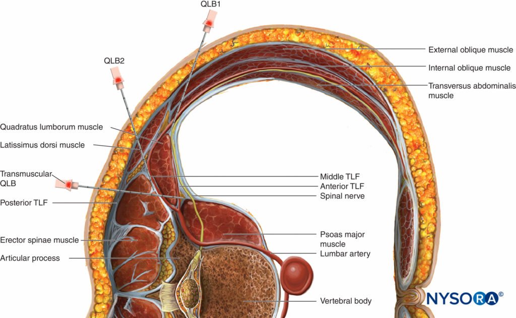 Quadratus Lumborum Block - Types, Technique, Indication