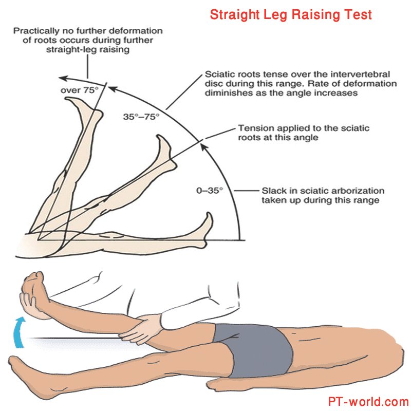 Straight Leg Raising Test (SLRT)