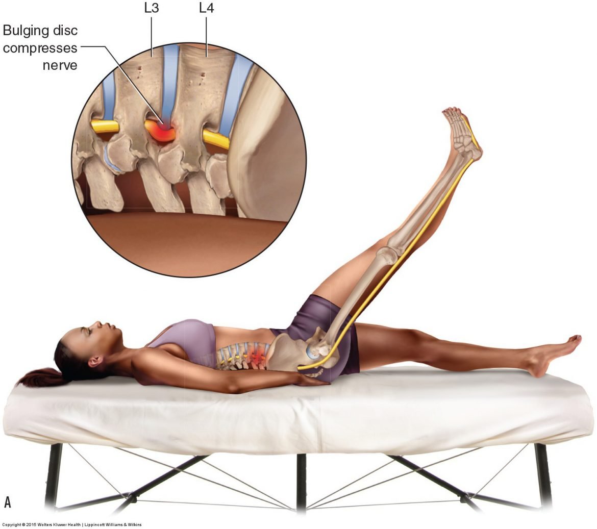 Straight Leg Raising Test (SLRT)