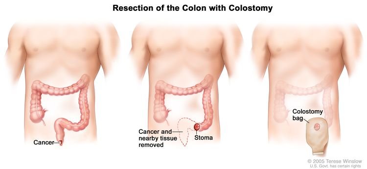 Anal Cancer - Causes, Symptoms, Diagnosis, Treatment Anal Cancer - Causes, Symptoms, Diagnosis, Treatment