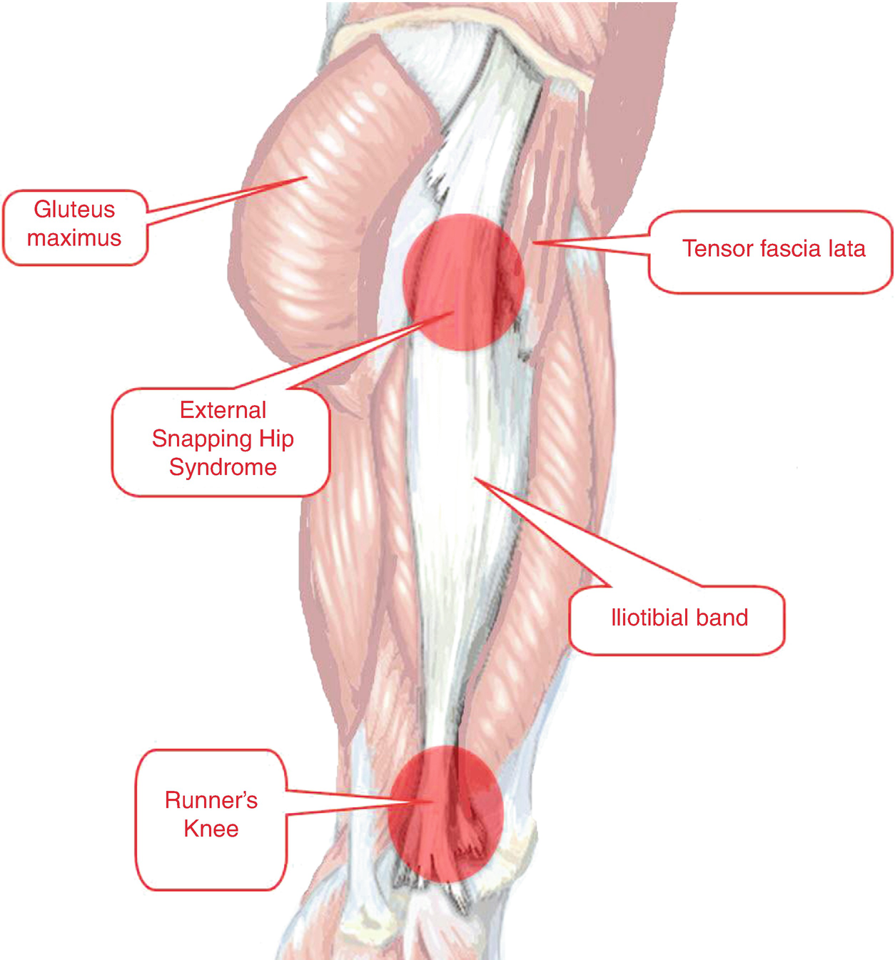 Snapping Hip - Causes, Symptoms, Diagnosis, Treatment