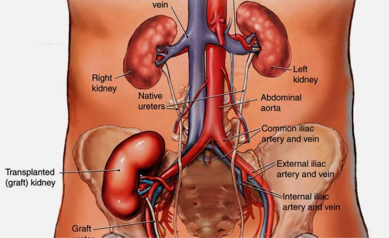 Kidney Transplant - Causes, Indications, Treatment