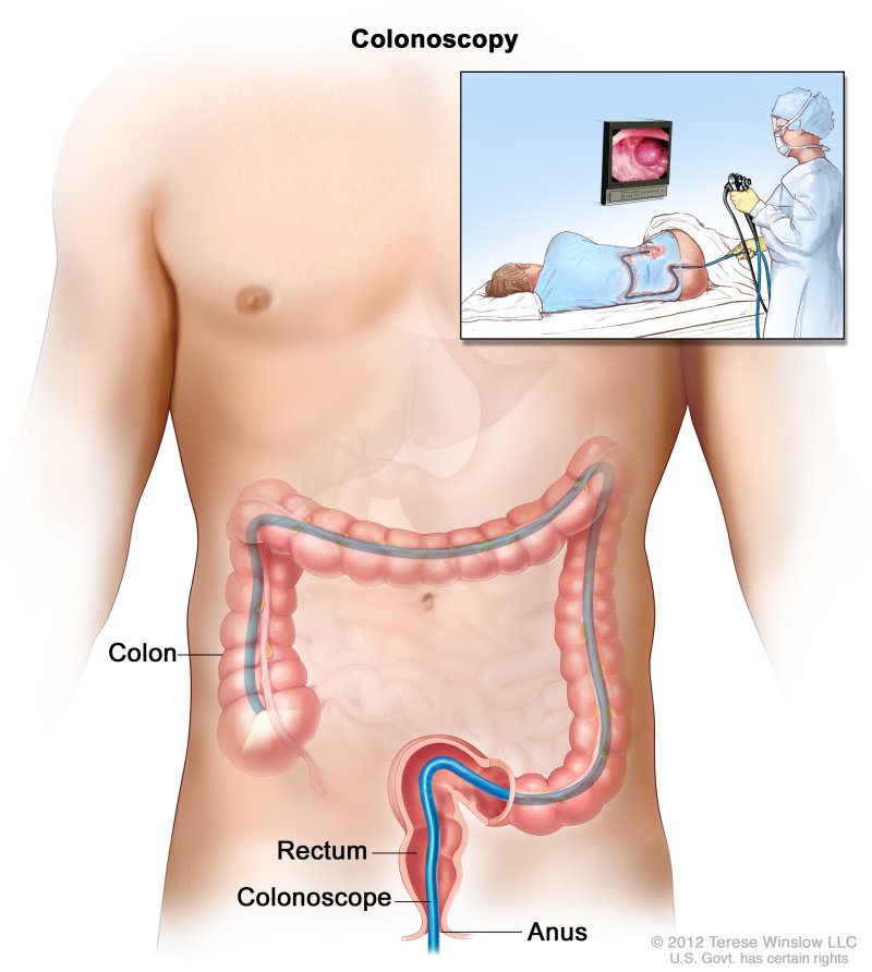 Rectum Cancer - Causes,Symptoms, Diagnosis, Treatment
