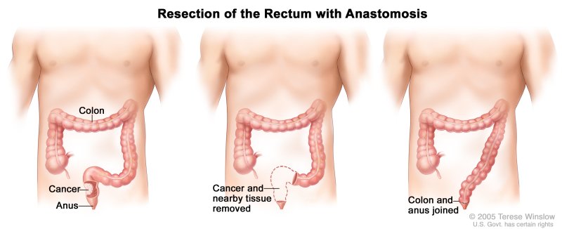 Rectal Cancer - Causes, Symptoms, Diagnosis, Treatment