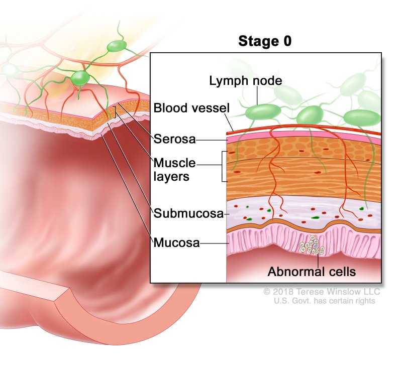 Rectal Cancer - Causes, Symptoms, Diagnosis, Treatment