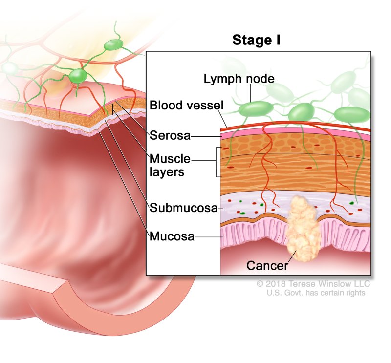 Rectal Cancer - Causes, Symptoms, Diagnosis, Treatment