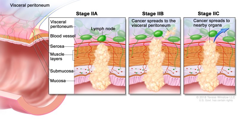 Rectal Cancer - Causes, Symptoms, Diagnosis, Treatment