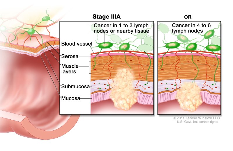 Rectal Cancer - Causes, Symptoms, Diagnosis, Treatment