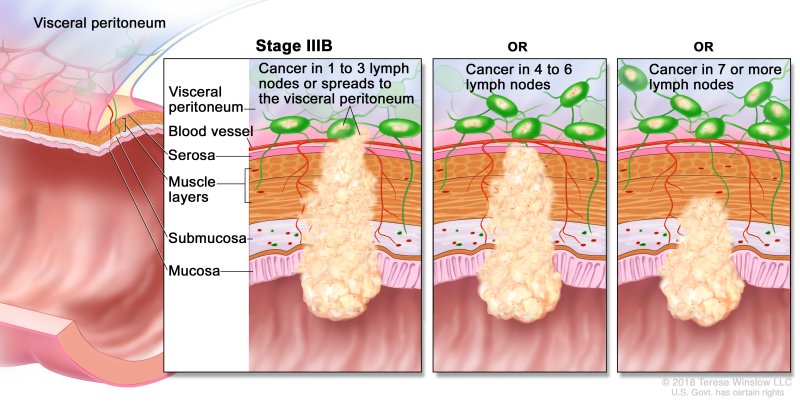 Rectal Cancer - Causes, Symptoms, Diagnosis, Treatment