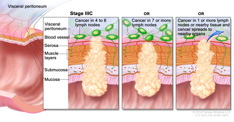 Rectal Cancer - Causes, Symptoms, Diagnosis, Treatment