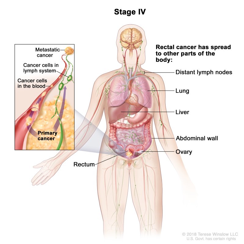 Rectal Cancer - Causes, Symptoms, Diagnosis, Treatment