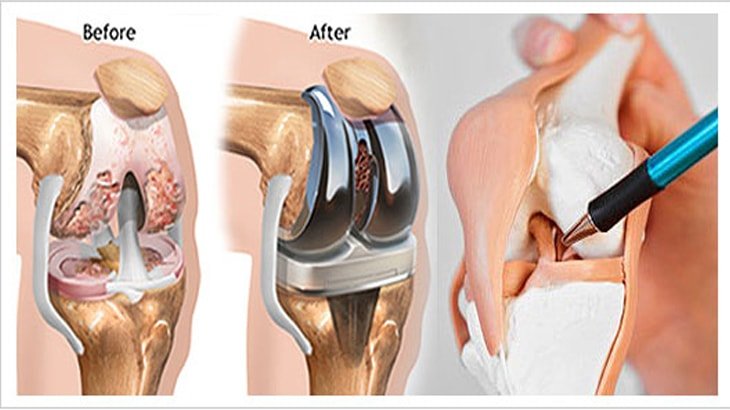 Causes of Total Knee Arthroplasty