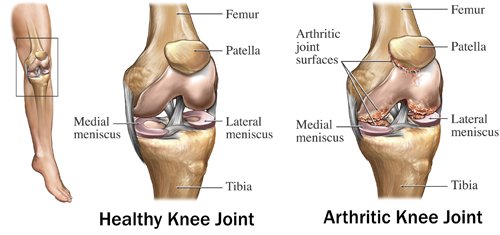 Causes of Total Knee Arthroplasty