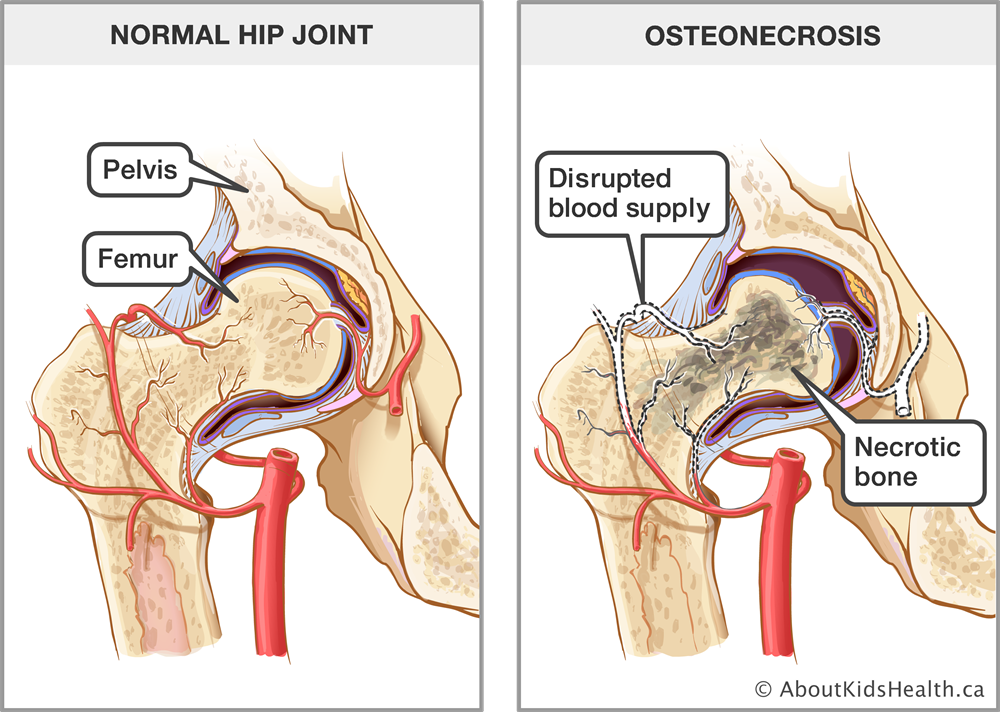 Ischemic Necrosis of Bone - Causes, Symptoms, Treatment