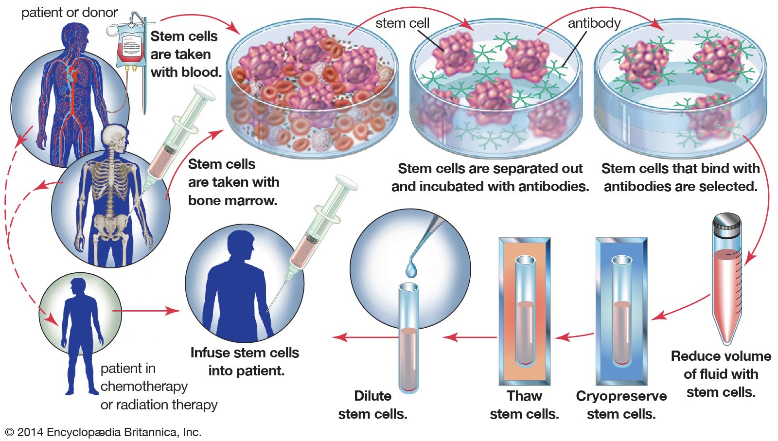 Bone Marrow Transplant - Indications, Contraindications