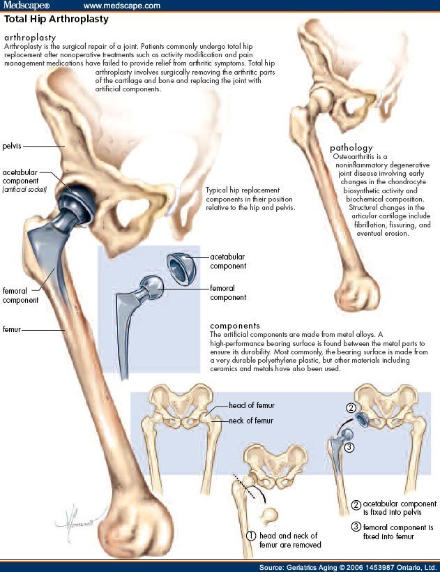 What Is Total Hip Arthroplasty?