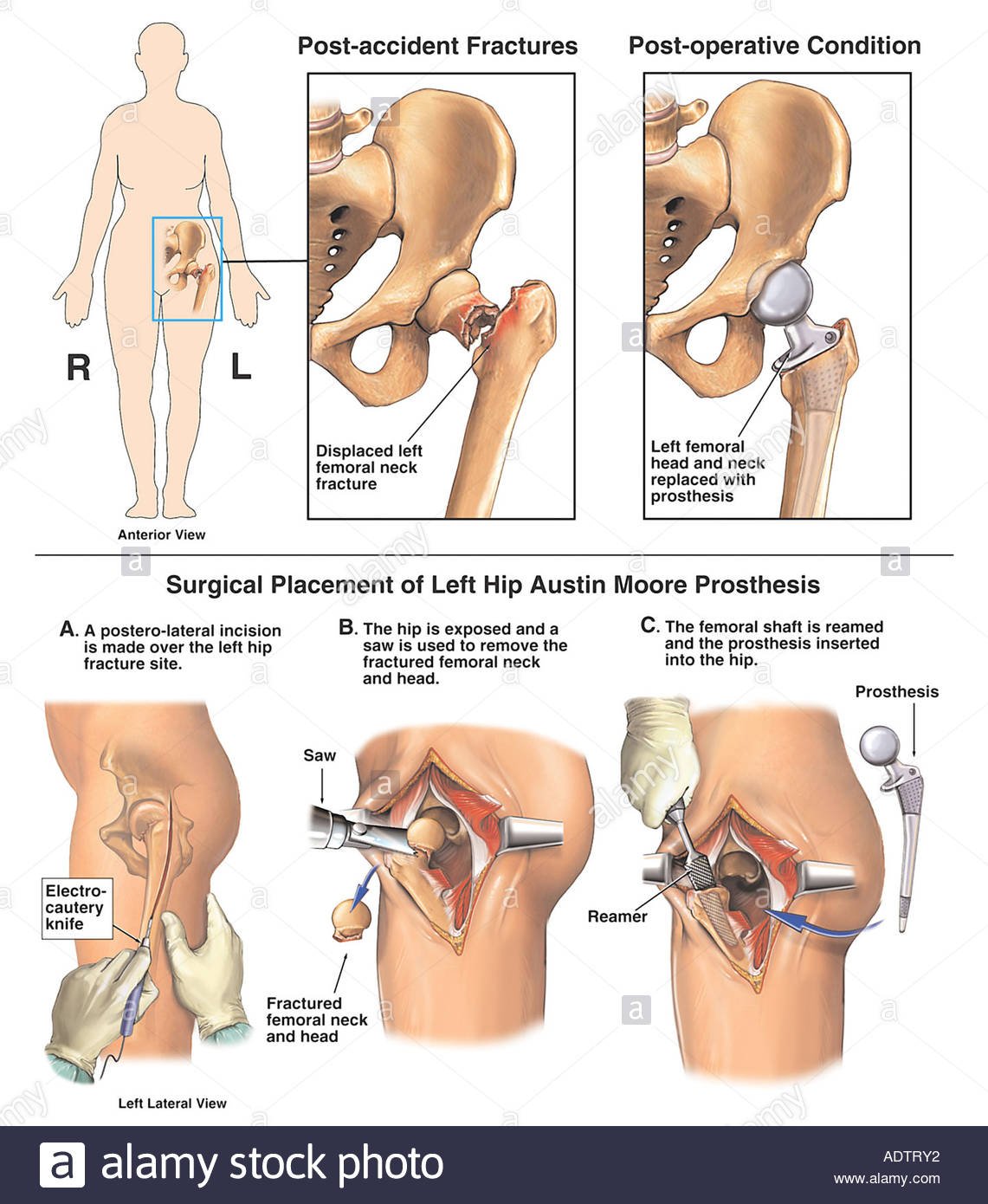 Ischemic Necrosis of Bone - Causes, Symptoms, Treatment