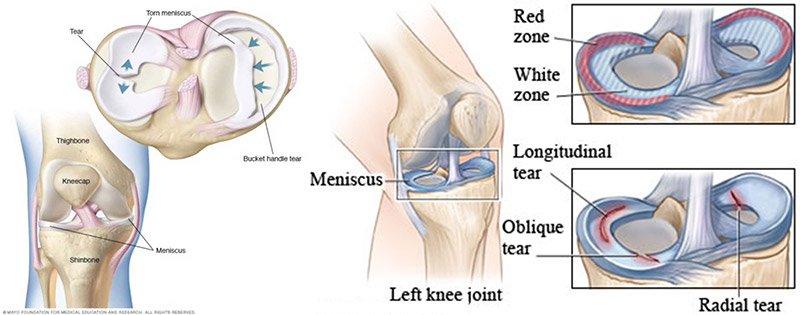 Lateral Meniscus Injury - Causes, Symptoms, Treatment