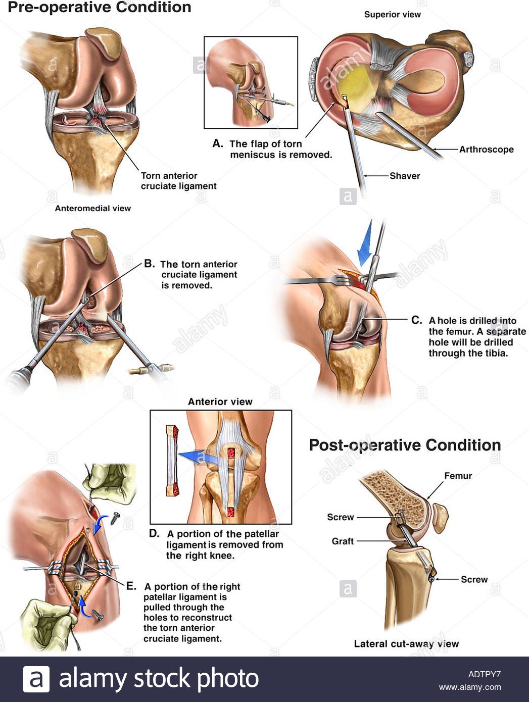 Lateral Meniscus Injury - Causes, Symptoms, Treatment