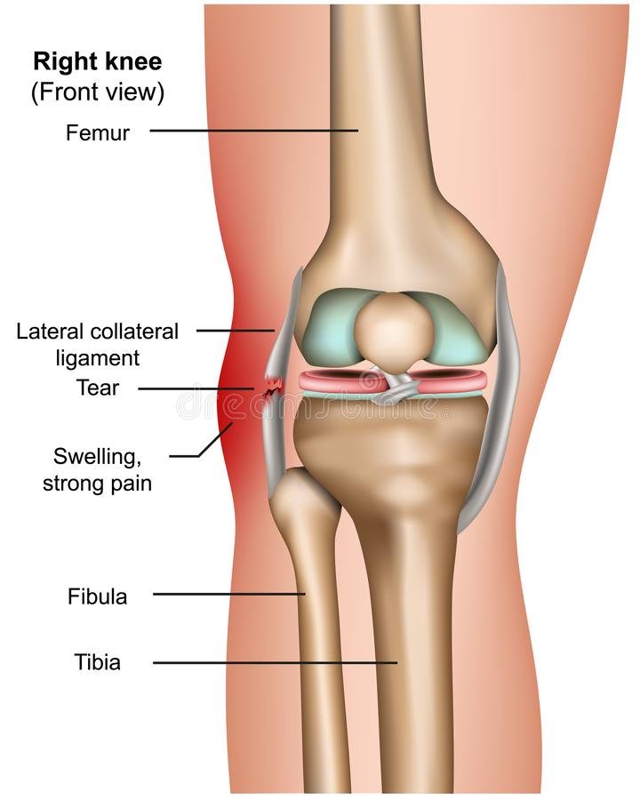 Lateral Collateral Ligament Injury - Symptoms, Treatment