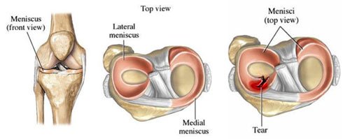 Medial Meniscus Injury - Causes, Symptoms, Treatment