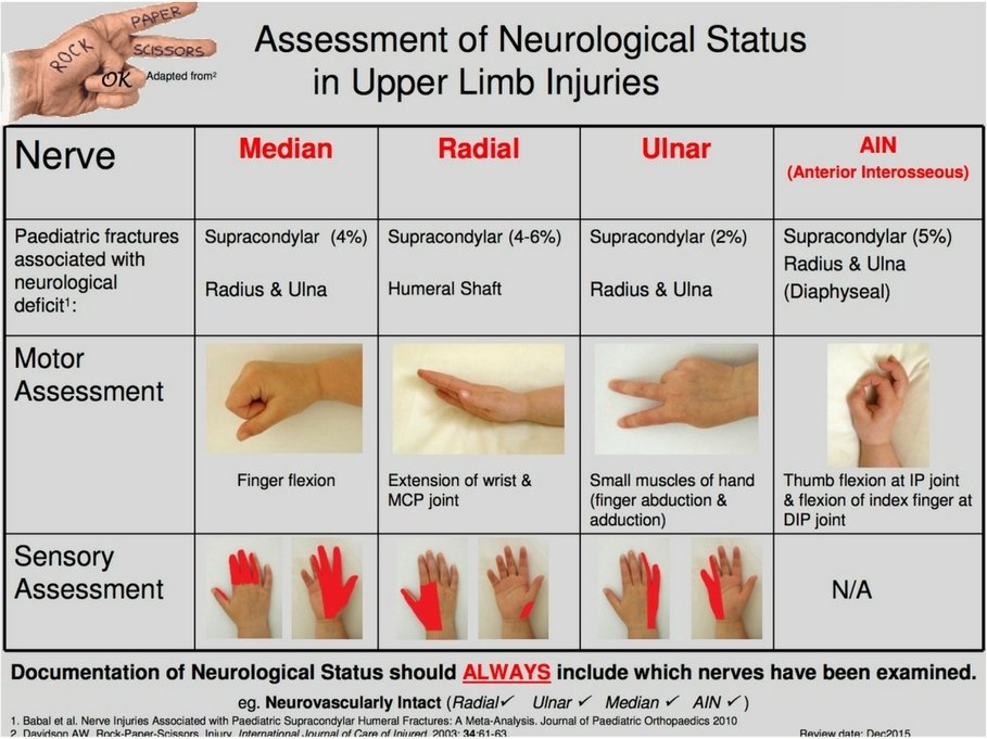 Median Nerve Neuropathy - Causes, Symptoms, Treatment