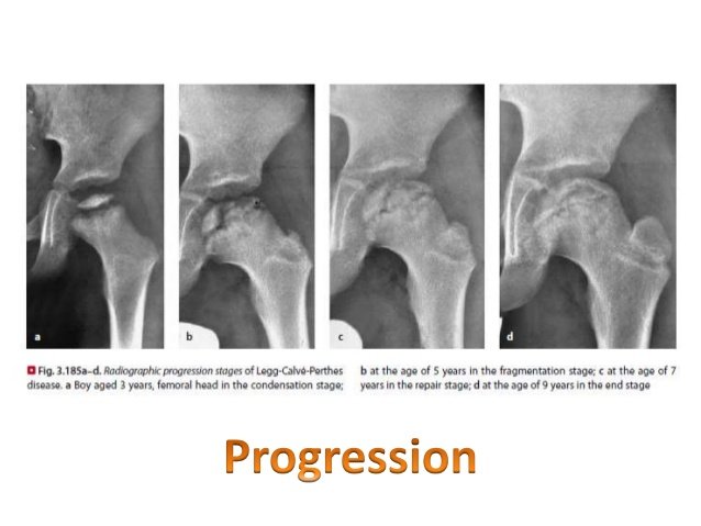 Ischemic Necrosis of Bone - Causes, Symptoms, Treatment