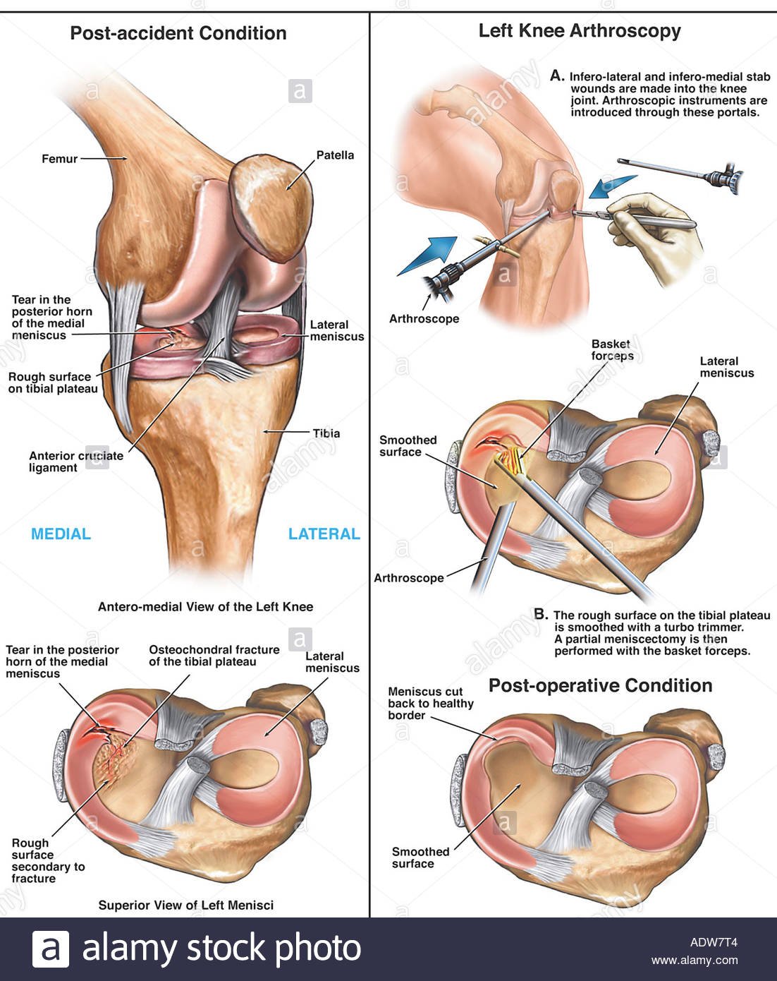 Total Knee Replacement (TKR) Techniques