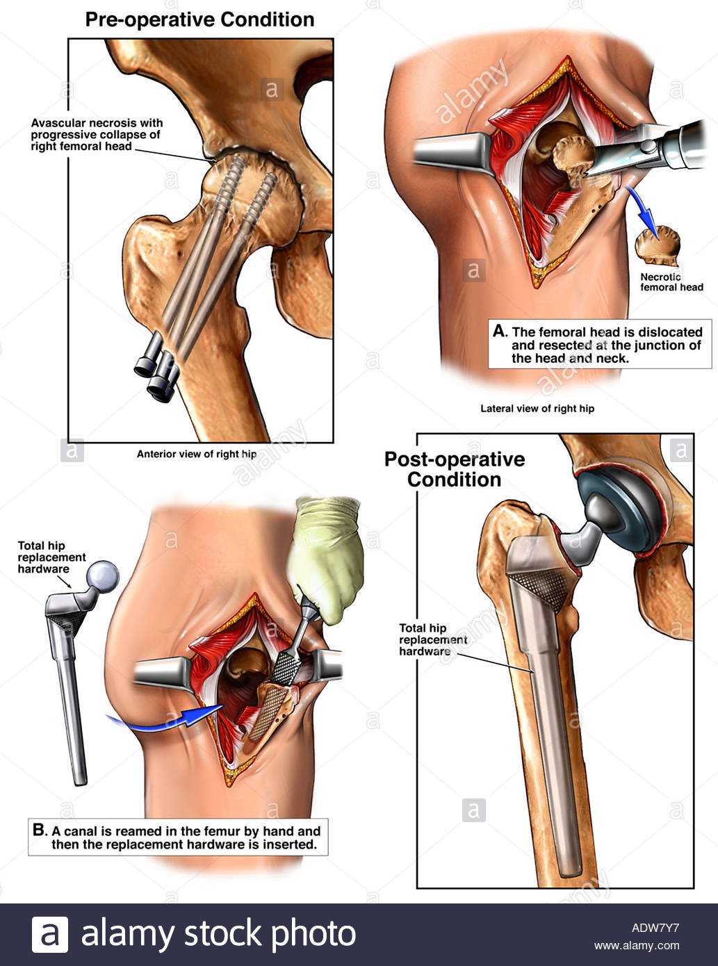 Ischemic Necrosis of Bone - Causes, Symptoms, Treatment